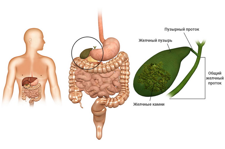 Проблеми з жовчним міхуром: симптоми, лікування, профілактика