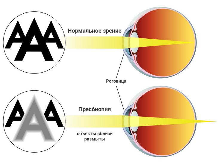 Пресбіопія: що це таке і як лікувати